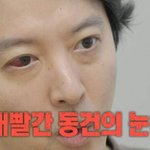 이동건, ‘새빨간 눈’ 1% 희귀병 진단 “송곳으로 찌르는 고통”