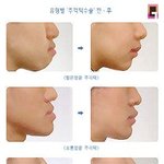[드루와] 얼굴은 괜찮은데 턱 이런 남자 어떰