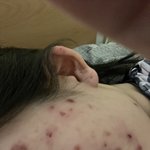 [어케생각해] 이 정도면 피부과 가야겠지??(약혐주의)