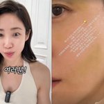  안면마비 후유증 치료 중 '악재'…"얼굴 <b>피멍</b>에 붓기까지"