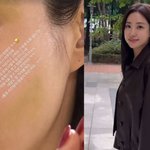 치료하다 부작용 얻어 "볼과 <b>눈가</b>에 멍이.." [RE:스타]