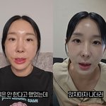  시술 후 확 달라졌다…"실 <b>리프팅</b>, 광고 아닌 내돈내산" (관종언니)[종합]