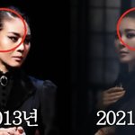  모발 이식 후 심각한 부작용 "<b>잔머리</b> 실종, 헤어라인에 충격"