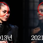 탈모→모발이식 고백..부작용에 '스트레스' "<b>잔머리</b> 실종"(눙주현)