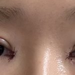 쌍수 재수술 자연유착으로 <b>당일</b>