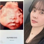 시험관 끝 기적' 양현민최참사랑, 딸 <b>초음파</b> 공개…"엄마 닮으렴"