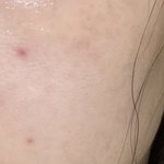 아니 진심 <b>뾰루지</b> 자국 어떻게 없애는거야?