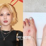 임신설에 다이어트→49kg 진입…타투 지운 <b>상처</b>투성이 발 '눈길'