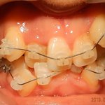 <b>치아</b> 교정 ㄹㅈㄷ