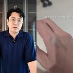 '박지윤 이혼' 최동석, <b>손등</b> 긁히고 멍든 안타까운 소식 "내가...