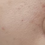 [댓글부탁해] 약혐)여드름있는 <b>판녀</b> 들어와바..