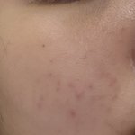 엄마한테 피부과 가는거 어케 <b>허락</b>받음