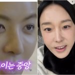 180도 확 달라졌다..'코성형' 강남→이지혜도 '인중축소술' 눈길...