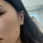 여드름약 (이<b>소티</b>논) 4개월 후기