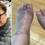 마비 25년' 강원래 발 상태…"발톱 빠져도 <b>통증</b> 못 느껴"