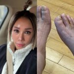  하반신 마비 강원래 부종 심각… “발톱 빠져도 <b>통증</b> 못 느껴”