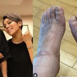 '하반신 마비' 강원래 발 상태 공개… "<b>발톱</b> 빠져도 감각 없다"