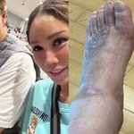 "하반신 마비 25년차, 발톱 빠져도 <b>통증</b> 못 느껴" [RE:스타]