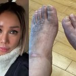 [드루와] 김송, 하반신 마비 25년 강원래 발 상태 애틋 “예전...