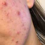 <b>겨울철</b> 피부고민.. ㅠㅠ 어떻게해 살려줘