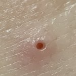 <b>이마</b>에 구멍 뚫렸는데 흔적 남을까