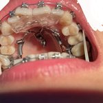 [댓글부탁해] 교정이 너무 힘든데 어카지