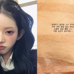  성형 후 심각한 눈 <b>질환</b>…“앞 못 보고 눈물만“ [RE:스타]