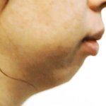 <b>무턱</b> 얼굴