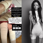 최준희, 루푸스+림프종 고통 심각 "살 찢어지고 림프액 줄줄....