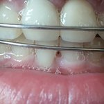 [댓글부탁해] 교정 유지<b>장치</b> 하는 판녀들아