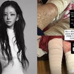  '뼈말라' 전 충격적 <b>몸상태</b>…"림프액 줄줄, 살 다 찢어져"...