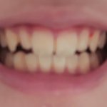 [댓글부탁해] 이런 치아는 교정 해야해?