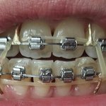 [조언부탁해] 나 어떡해 <b>치아</b>교정 망한것같아…