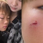 일…심각한 부상 당했다, <b>이수진</b> "6바늘 꿰매, 울고 불고"...