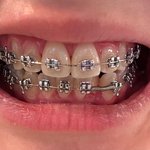 [댓글부탁해] 어캄 치아교정땜에 헤어질듯 ㅋㅋㅋㅋㅋㅋ