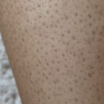 <b>모공</b>각화증이 때문에 스트레스인데 강남 피부과의사가 유전이라고 팩폭날림...