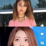 <b>허윤진</b> 윤곽 vs 보톡스