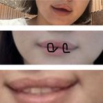 <b>입술필러</b>..녹일까?? 급행 댓글좀