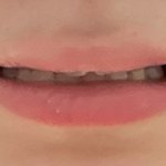 나 이거 교정 무조건 해야됨?ㅠㅠ