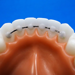 <b>치아</b> 유지장치는 고정식이 좋은듯