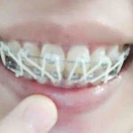 [댓글부탁해] 내 교정기 진짜 개조카 <b>밤</b><b>티</b>임;;