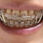 [댓글부탁해] 오늘 교정기 쪼이고온 <b>치아</b>교정 4년차 무물보