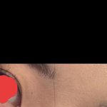 <b>앞트임</b> 할말??