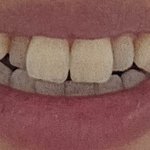 [댓글부탁해] <b>치아</b>교정 추반