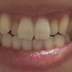 [댓글부탁해] <b>치아</b>교정 추반