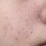 한달<b>동안</b> 피부 뒤집어진거 복구함