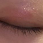 <b>눈두덩</b>이 따가운데