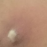 엉덩이에 <b>여드름</b>? 같은거 나면 어떻게해야해