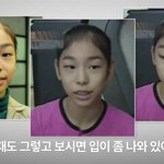 [<b>돌출</b><b>입</b>교정] <b>돌출입</b> 교정으로 예뻐진 김연아