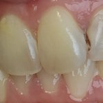 [이것좀봐줘] 내 <b>이빨</b> 좀 제발 도와주셈